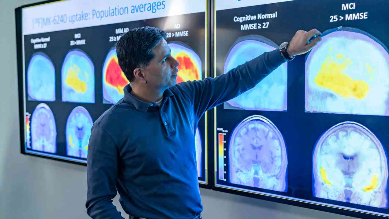 Lotta all'Alzheimer, quali sono i cibi da utilizzare