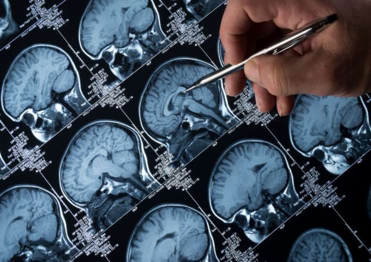 Ricerca contro l'alzheimer