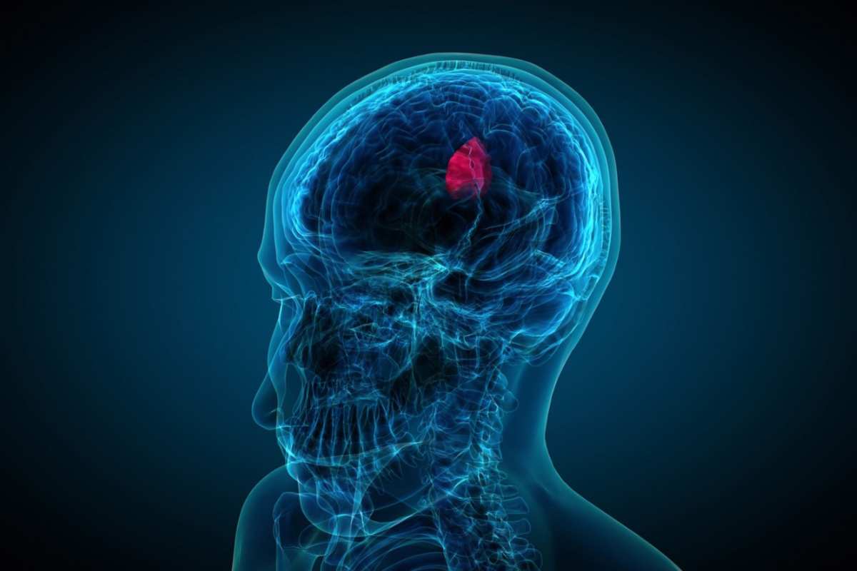 Glioma, tumore cresce con attività cervello: speranza da nuovo studio