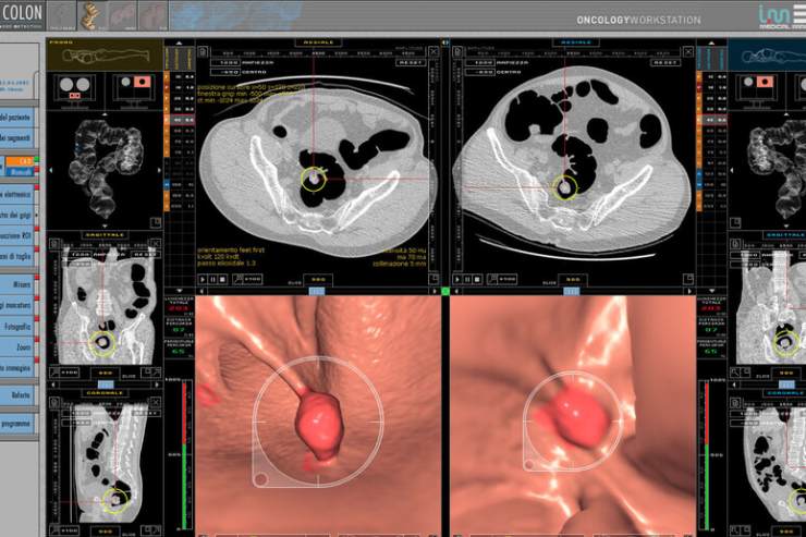 Tumori al colon-retto sempre più mortali