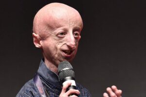 Cos'è la progeria, la malattia di Sammy Basso