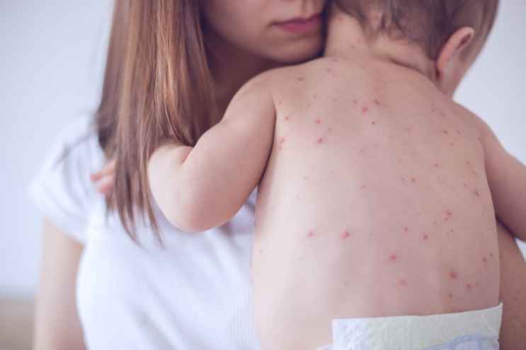 Bambino affetto da morbillo