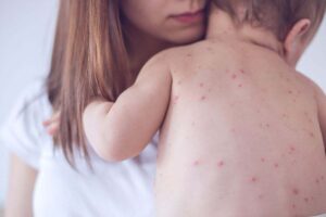 bambino con il morbillo in braccio alla mamma